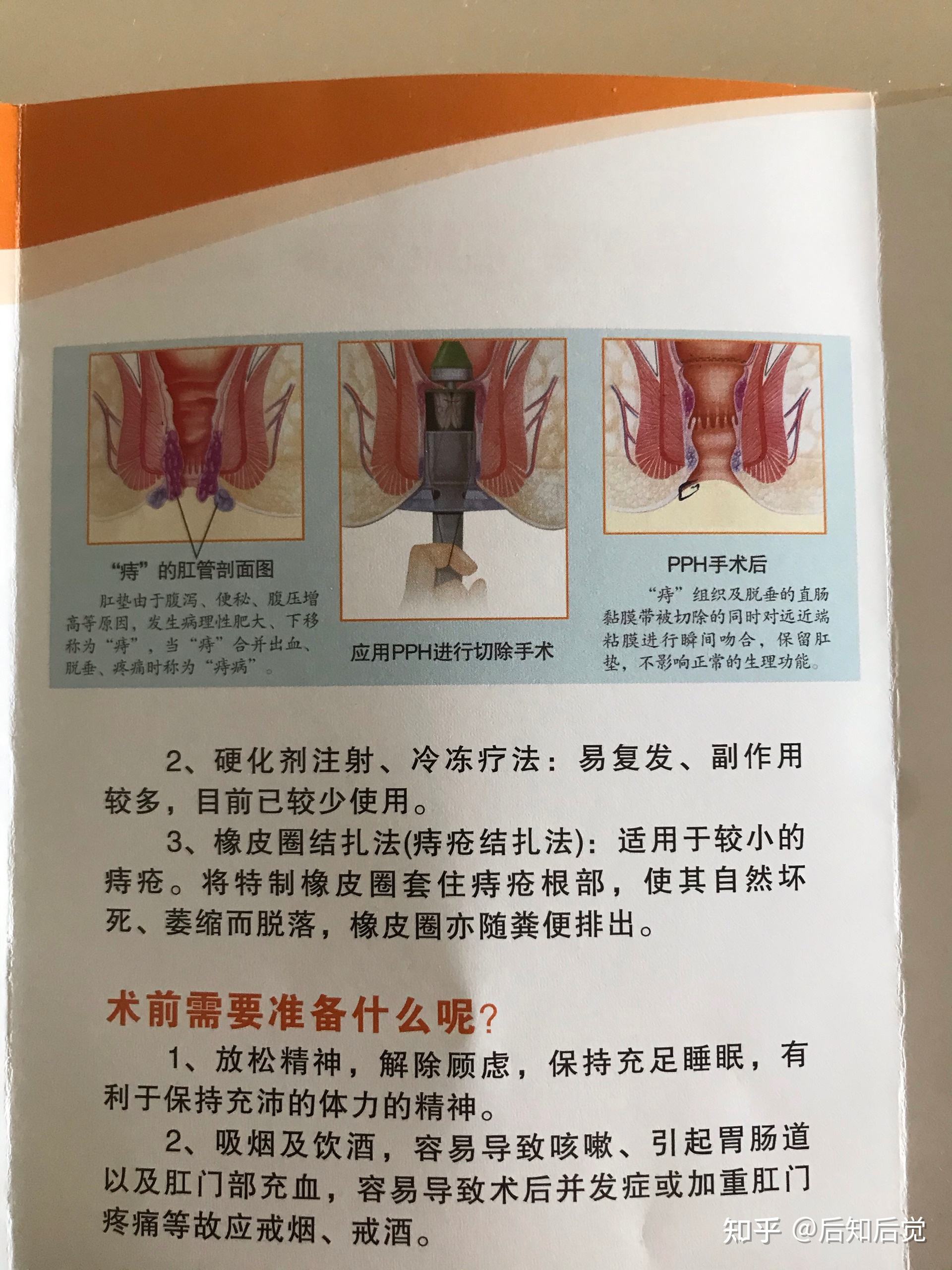 痔疮搞笑聊天记录(关于痔疮的搞笑文章)