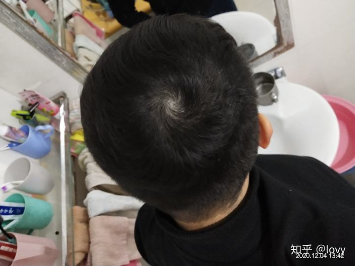脱发聊天记录大全(日本教授脱发聊天记录)